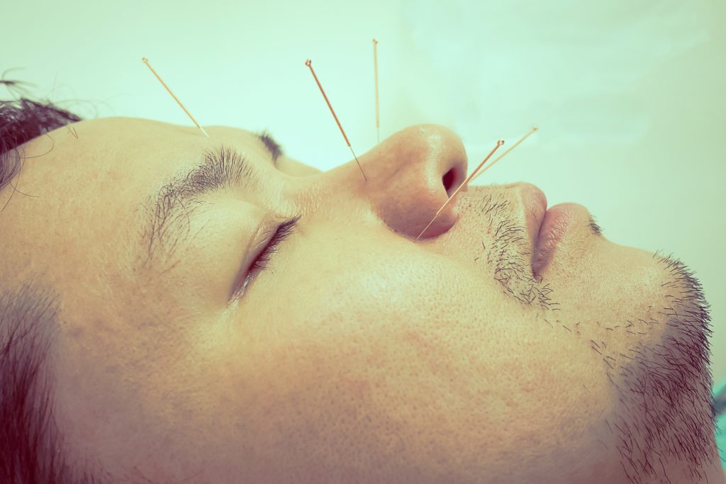Aculifting : acupuncture soin anti-âge du visage